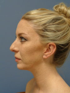 chin augmentation, blog, robbins plastic surgery