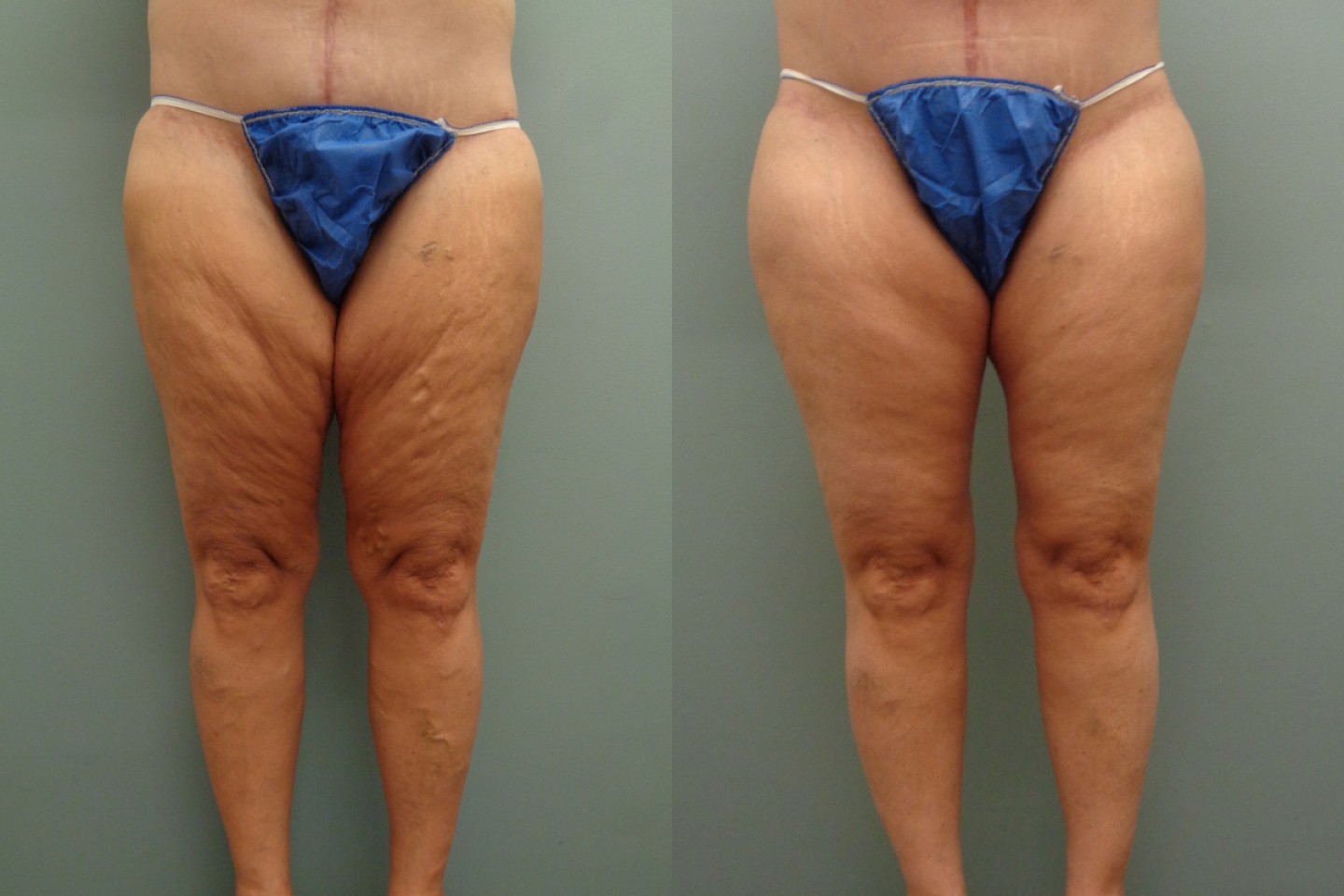Thigh Lift Before & After Pictures Nashville, Franklin, TN