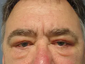 Blepharoplasty Before and After Pictures Nashville, TN