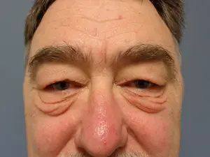 Blepharoplasty Before and After Pictures Nashville, TN