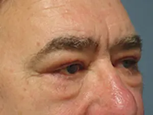 Blepharoplasty Before and After Pictures Nashville, TN