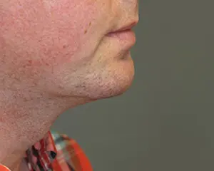 Chin Augmentation Before and After Pictures Nashville, TN