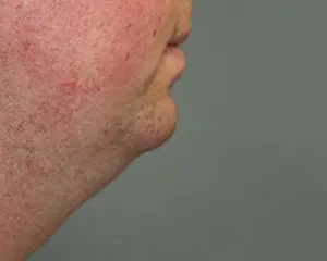 Chin Augmentation Before and After Pictures Nashville, TN