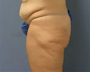 Butt Augmentation Before and After Pictures Nashville, TN