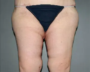 Thigh Lift Before and After Pictures Nashville, TN