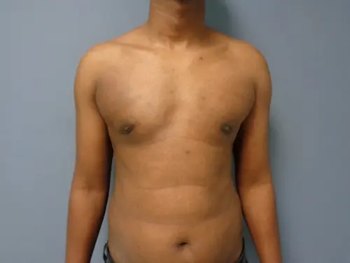 Gynecomastia Before and After Pictures Nashville, TN