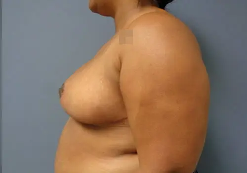 Breast Reduction Before & After Pictures in Nashville, TN
