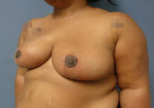 Breast Reduction Before & After Pictures in Nashville, TN