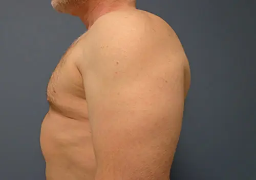 Gynecomastia Before and After Pictures Nashville, TN