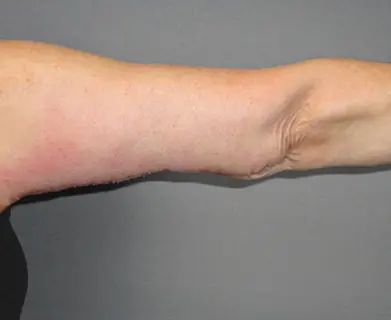 Arm Lift Before and After Pictures Nashville, TN