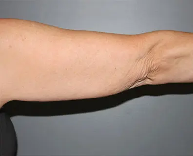 Arm Lift Before and After Pictures Nashville, TN