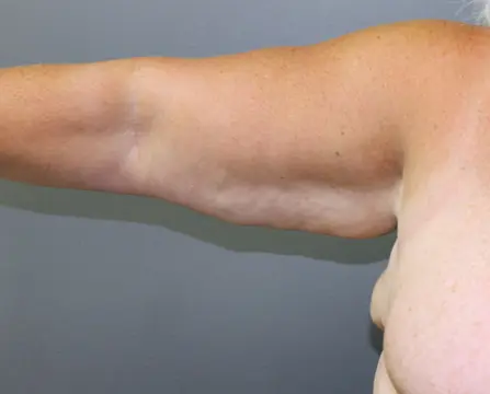 Arm Lift Before and After Pictures Nashville, TN