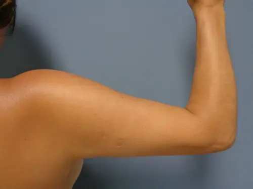 Arm Lift Before and After Pictures Nashville, TN