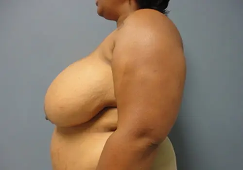 Breast Reduction Before and After Pictures Nashville, TN
