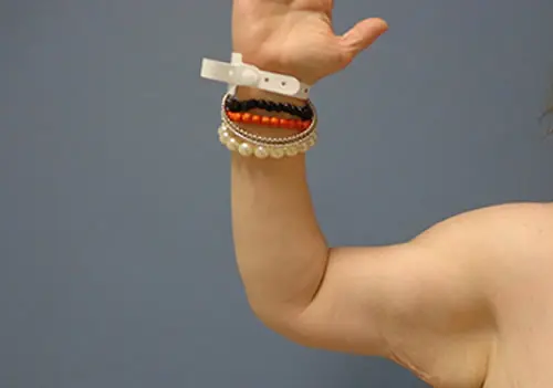 Arm Lift Before and After Pictures Nashville, TN