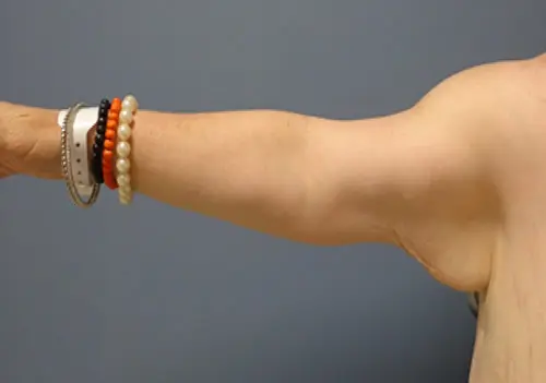 Arm Lift Before and After Pictures Nashville, TN