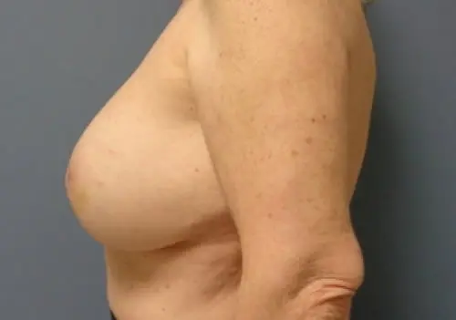 Implant Based Reconstruction Before and After Pictures Nashville, TN