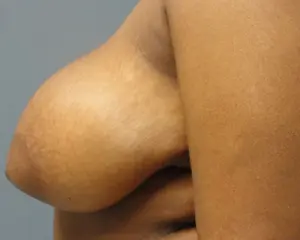 Breast Reduction Before and After Pictures Nashville, TN