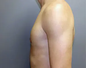 Gynecomastia Before and After Pictures Nashville, TN
