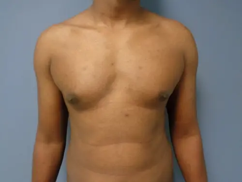 Gynecomastia Before and After Pictures Nashville, TN