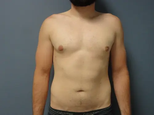 Gynecomastia Before and After Pictures Nashville, TN