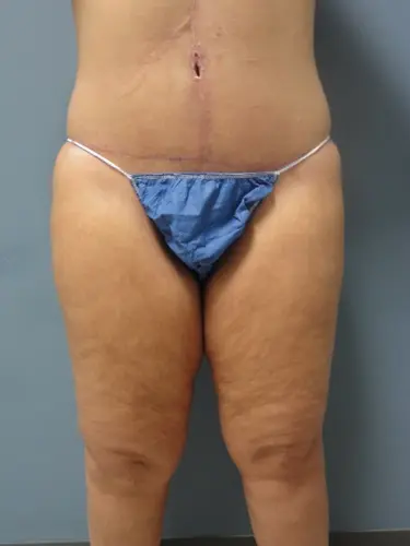 Liposuction Before and After Pictures Nashville, TN