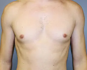 Gynecomastia Before and After Pictures Nashville, TN