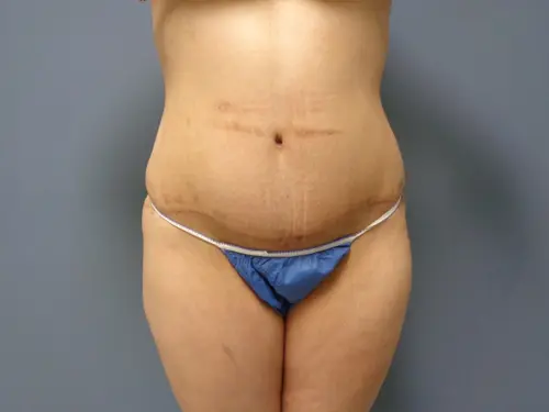 Tummy Tuck Before and After Pictures Nashville, TN