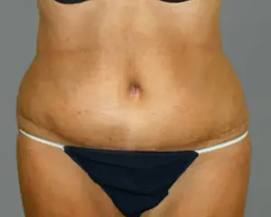 Tummy Tuck Before and After Pictures Nashville, TN