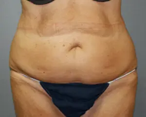 Tummy Tuck Before and After Pictures Nashville, TN