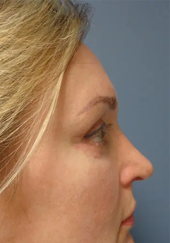 Rhinoplasty Before and After Pictures Nashville, TN