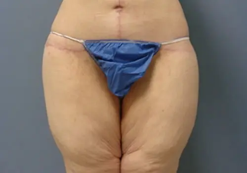 Thigh Lift Before and After Pictures Nashville, TN