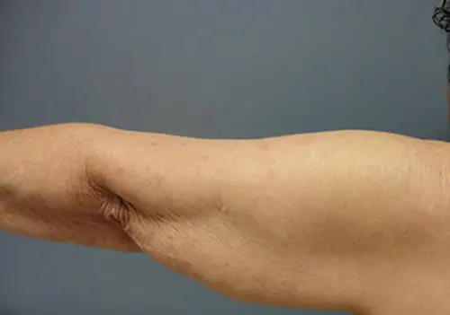 Arm Lift Before and After Pictures Nashville, TN