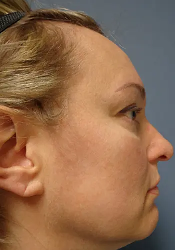 Rhinoplasty Before and After Pictures Nashville, TN