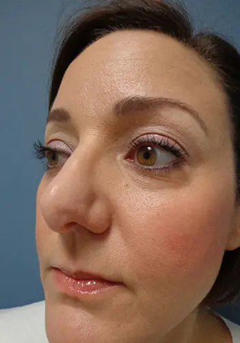 Rhinoplasty Before and After Pictures Nashville, TN