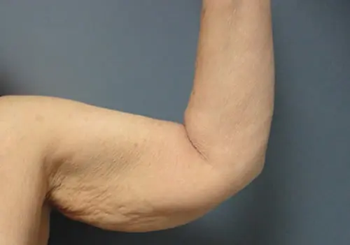 Arm Lift Before and After Pictures Nashville, TN