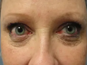 Blepharoplasty Before and After Pictures Nashville, TN