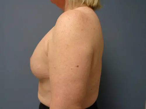 Breast Reconstruction Before and After Pictures Nashville, TN
