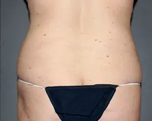 Liposuction Before and After Pictures Nashville, TN