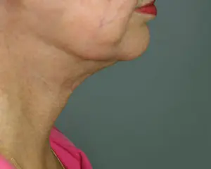 Neck Lift Before and After Pictures Nashville, TN