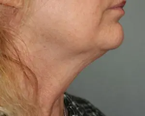 Neck Lift Before and After Pictures Nashville, TN