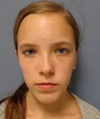Otoplasty Before and After Pictures Nashville, TN