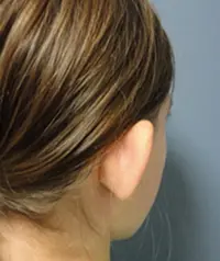 Otoplasty Before and After Pictures Nashville, TN