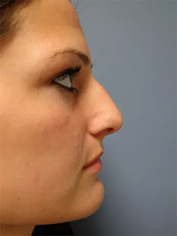 Rhinoplasty Before and After Pictures Nashville, TN