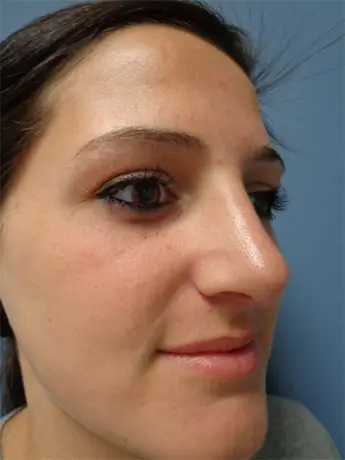 Rhinoplasty Before and After Pictures Nashville, TN