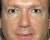 Rhinoplasty Before and After Pictures Nashville, TN