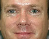 Rhinoplasty Before and After Pictures Nashville, TN
