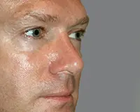 Rhinoplasty Before and After Pictures Nashville, TN
