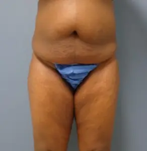 Thigh Lift Before and After Pictures Nashville, TN