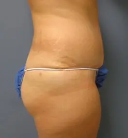 Tummy Tuck Before and After Pictures Nashville, TN